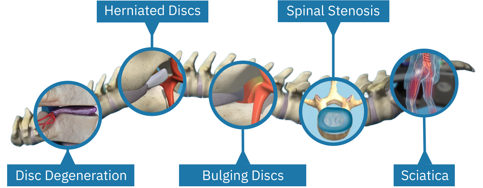 Degenerative Disc Disease Dallas, Spinal Disc Repair Fort Worth